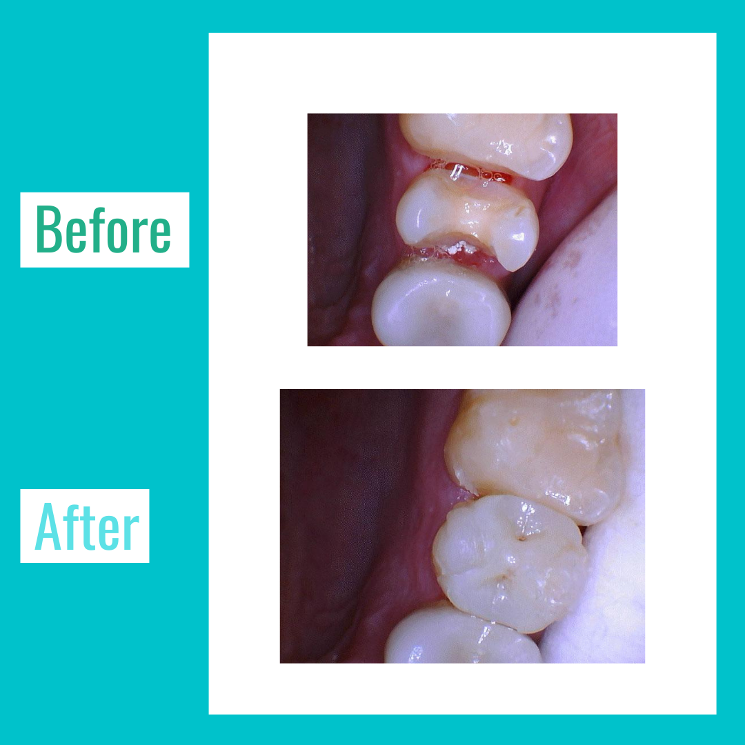 Dental-Fillings-Lasry-Dental-Clinic-1