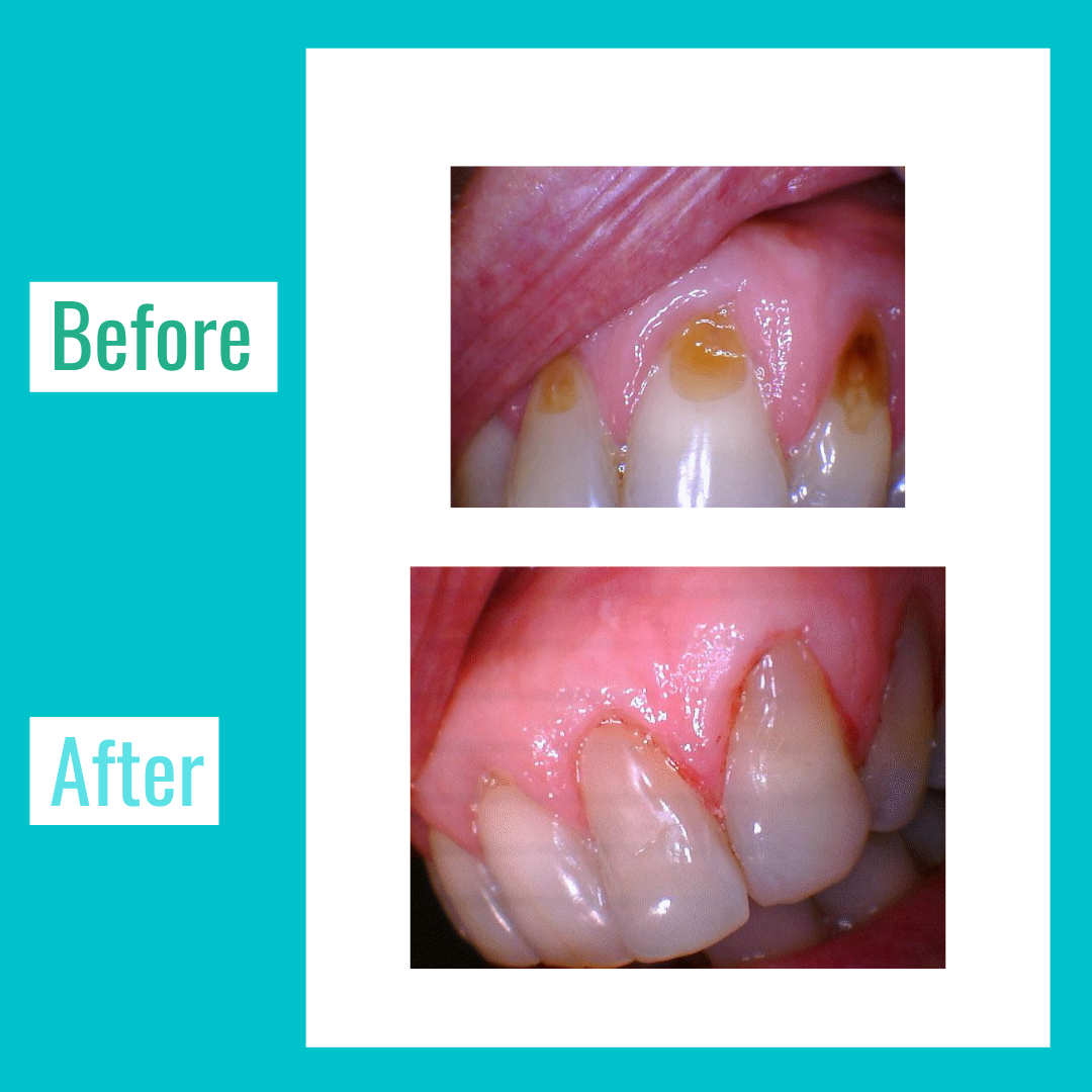 Dental-Fillings-Lasry-Dental-Clinic-2