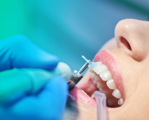 Professional Teeth-cleaning | Lasry Dental Clinic