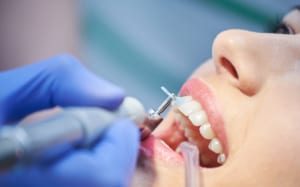 Professional Teeth Cleaning | Lasry Dental Clinic