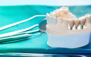 Crowns and Bridges | Lasry Dental Clinic