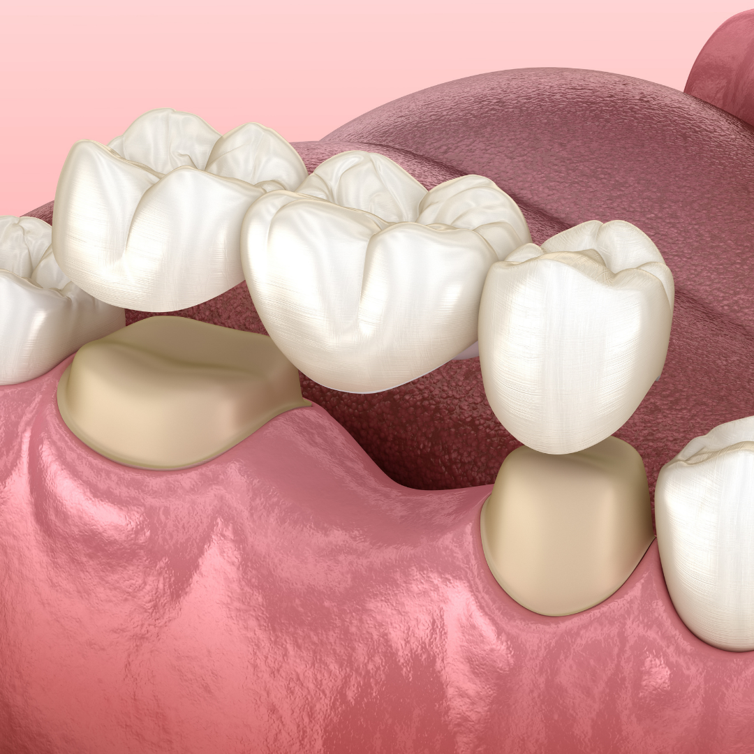Crowns-Bridges-Dentistry-Lasry-Dental-Clinic-3