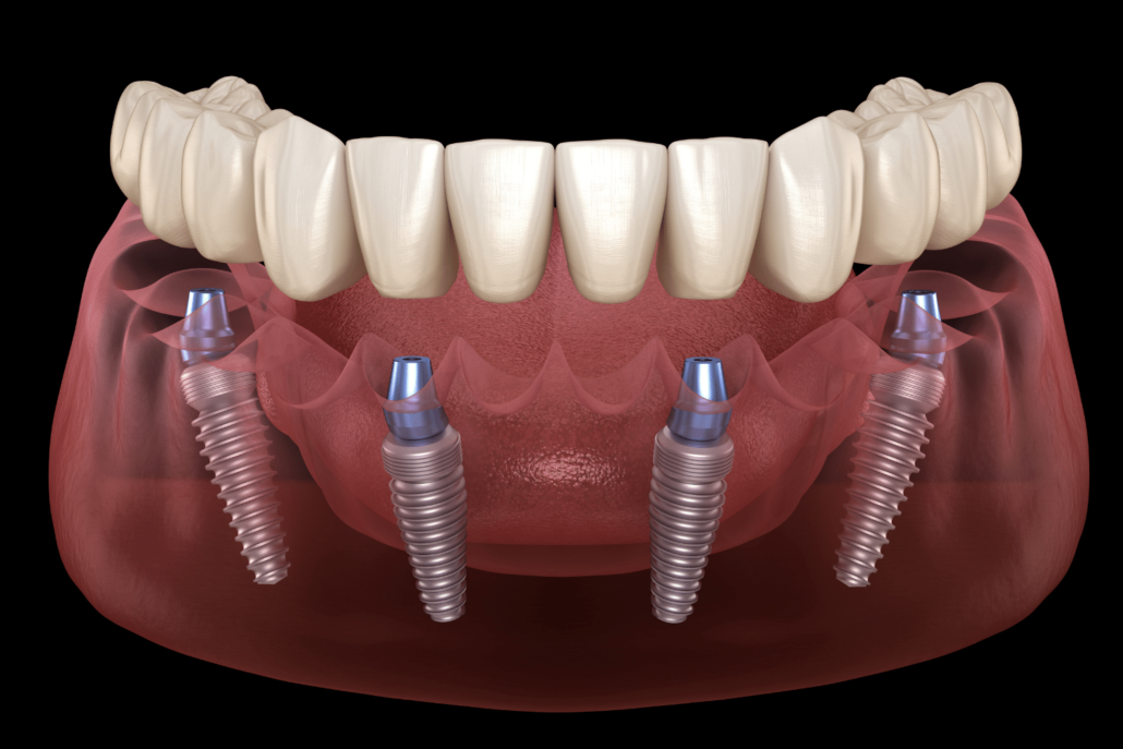 Full-Mouth-Restoration-Lasry-Dental-Clinic-Los-Angeles-California