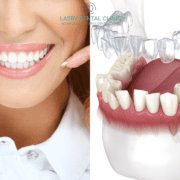 Invisalign in Los Angeles: do you really need it?