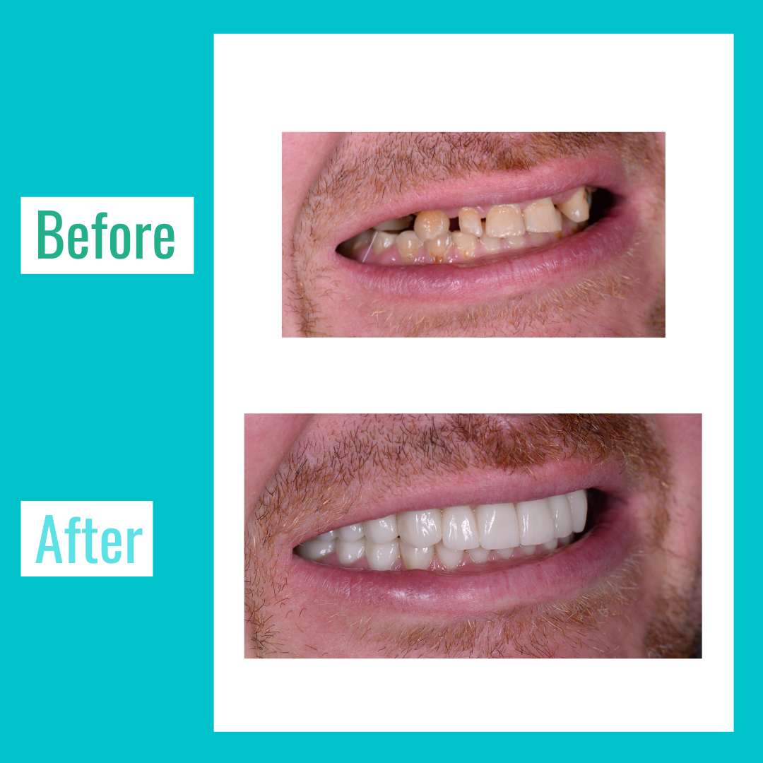 veneers-before-and-after