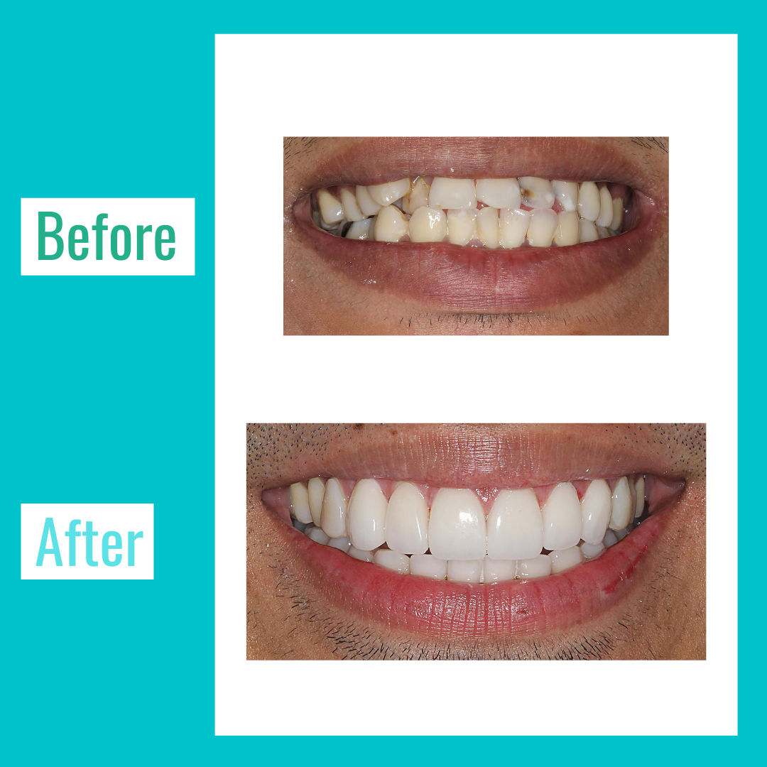 veneers-before-and-after