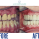 Full Mouth Reconstruction before and after