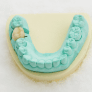 what-is-a-dental-crown