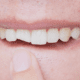 what-to-do-about-chipped-teeth