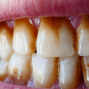 teeth-discoloration