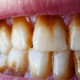 teeth-discoloration