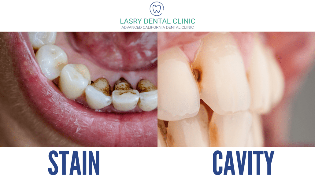 teeth-stain-vs-cavity