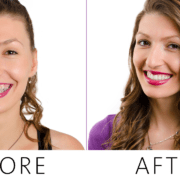 teeth-after-braces