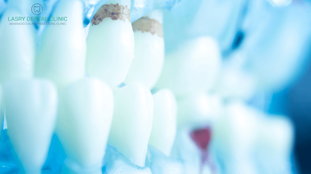 teeth-plaque