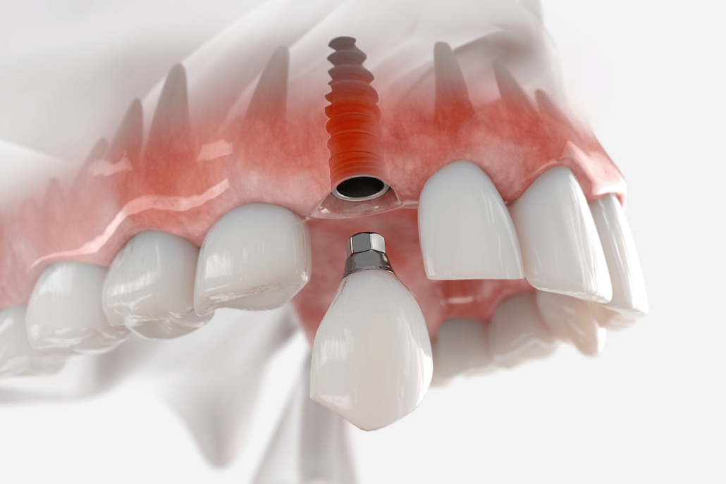 Dental-Implants-Lasry-Dental-Clinic-Los-Angeles-California