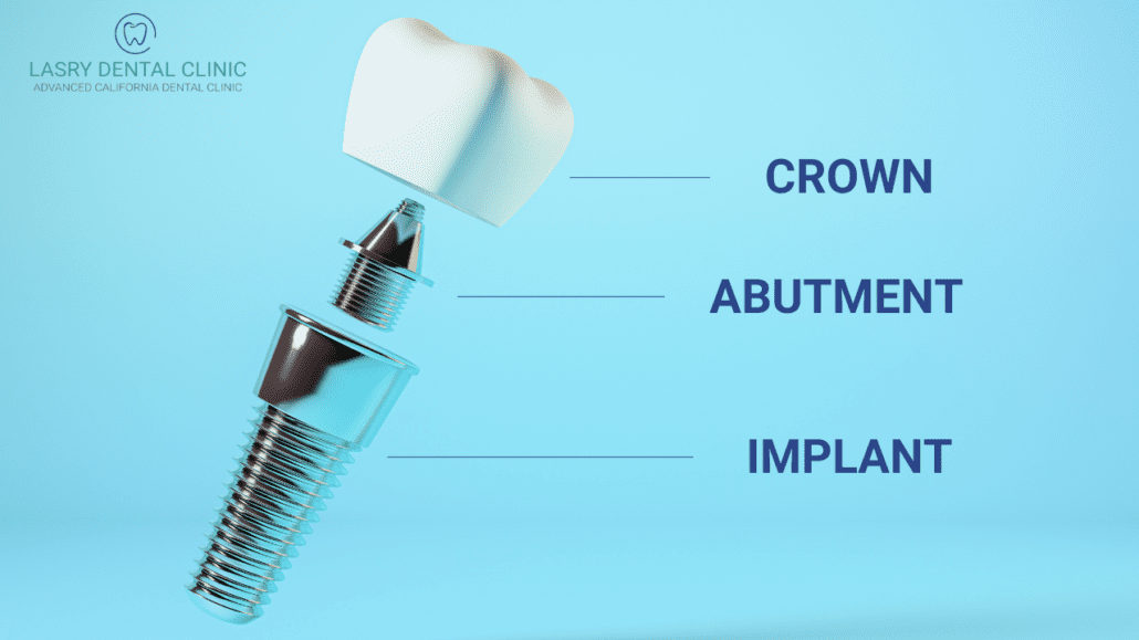 dental-implant-cost