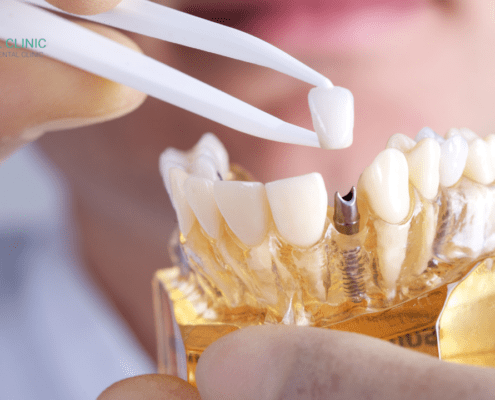 dental implant pictures