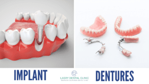 dental-implant-dentures