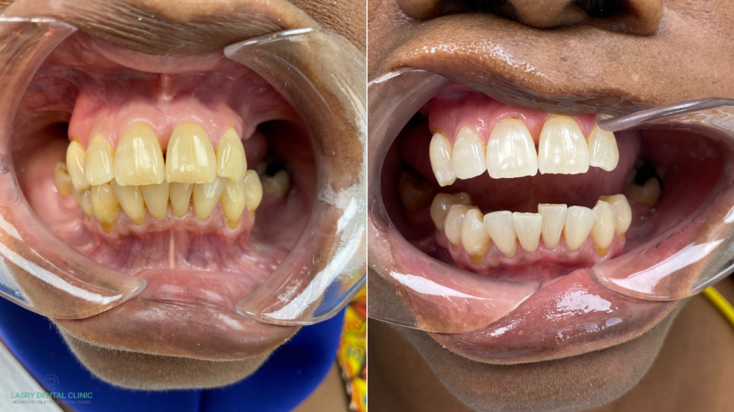 teeth-whitening-zoom