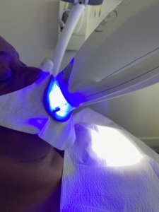 teeth whitening zoom vs laser