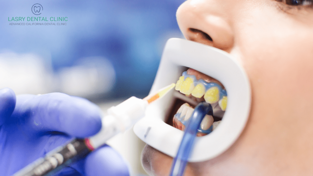 teeth bleaching vs teeth whitening