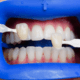 teeth-bleaching-by-dentist