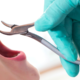tooth-extraction-cost 