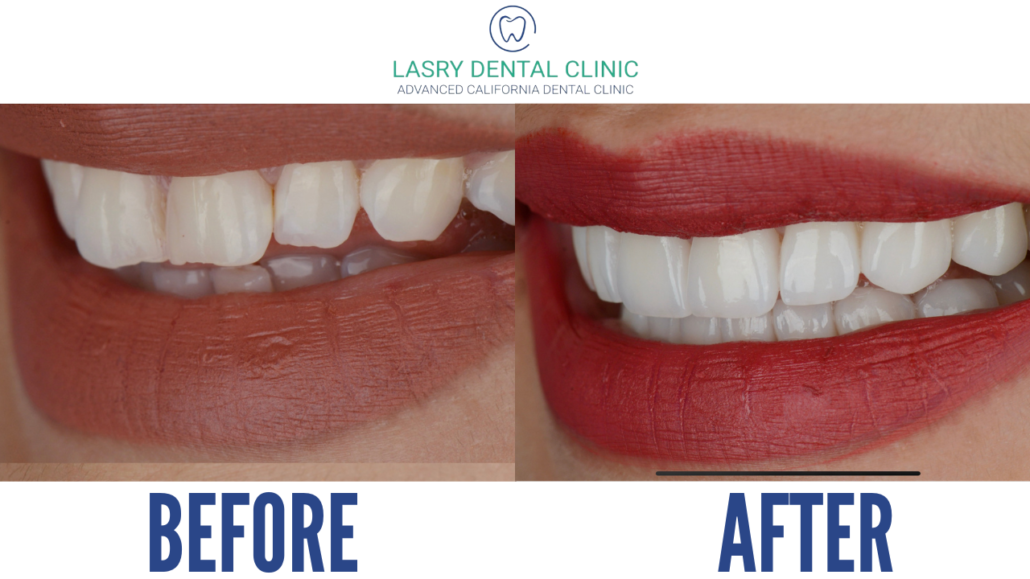 woman before and after porcelain veneer transformation