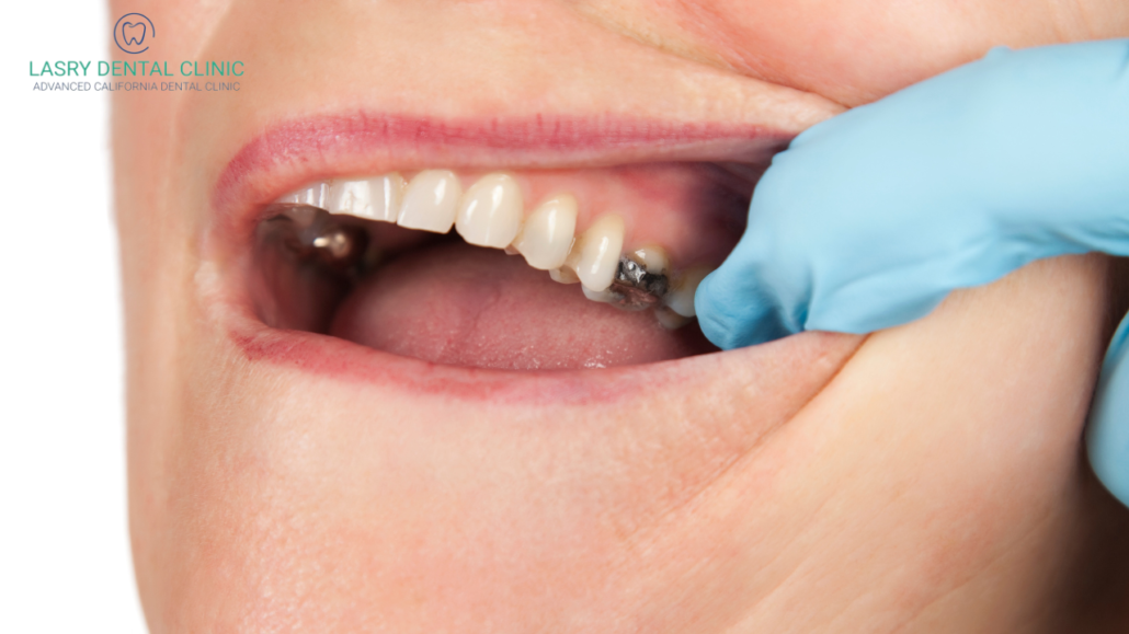 tooth decay treatments include fillings