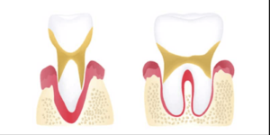 Advanced stages of Periodontal Disease