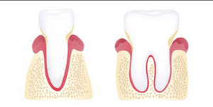 early-stage-Periodontal-Disease