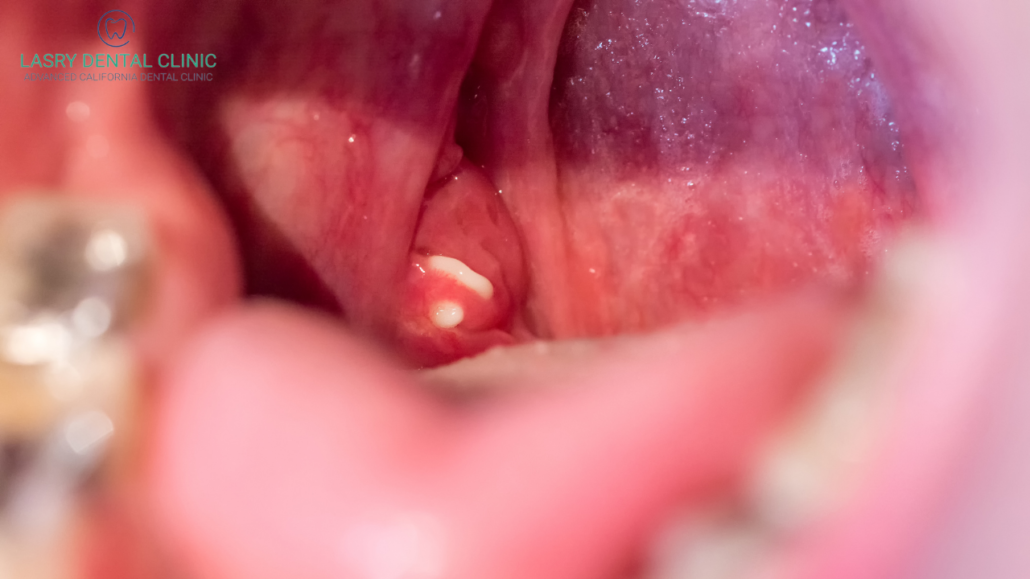 tonsil stones how to prevent