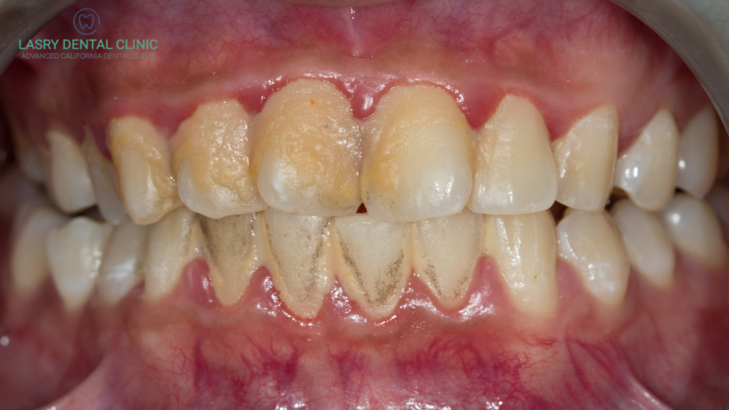 dental plaque or teeth plaque pic