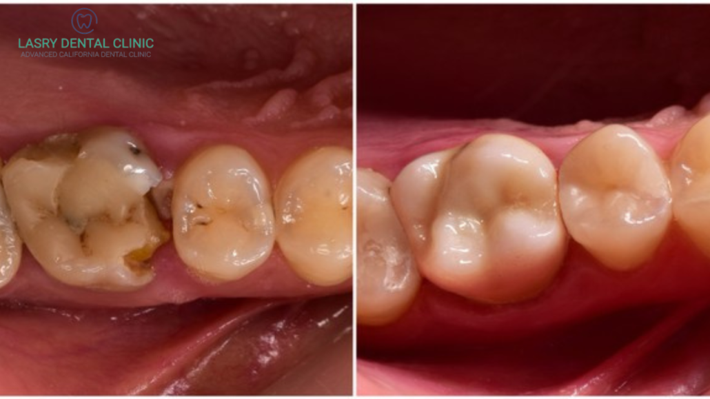 symptoms of rotting teeth