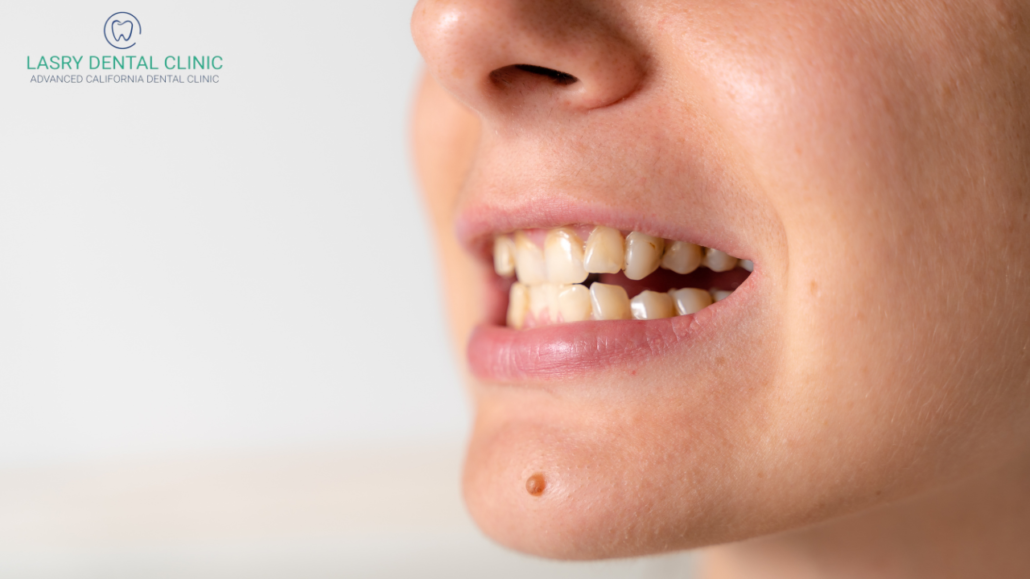 woman smiling to show bad teeth