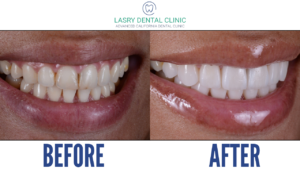 before and after veneers for a perfect smile - Lasry Dental Clinic in Los Angeles