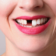 woman with missing front tooth