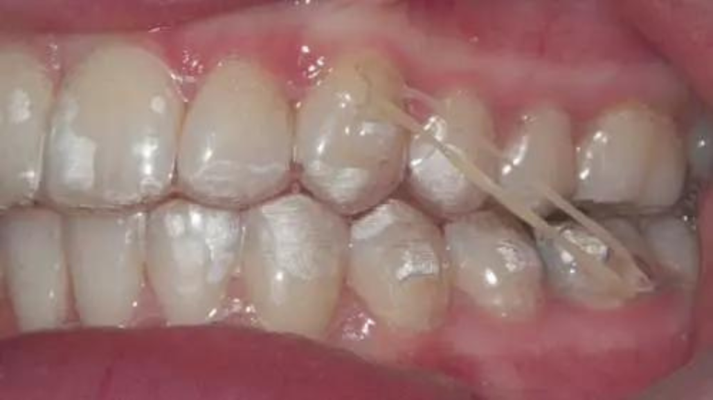 Invisalign with rubber bands