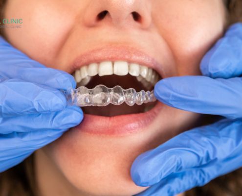 dentist putting Invisalign with attachments on patient's teeth